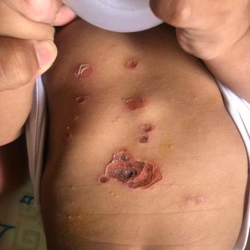 ลูกเป็นแผลแล้วลามไปที่อื่น