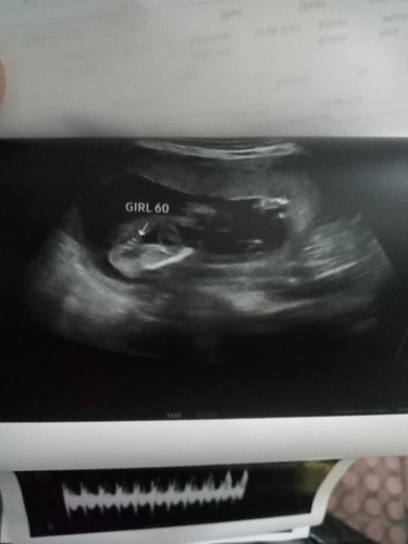 60% GurL (18weeks)