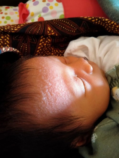 Bintik² di dahi bayi new born 5 hari