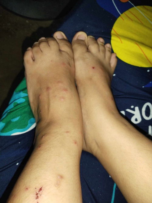 Anong pwedeng gamot dito?