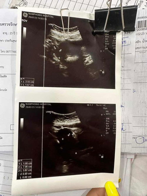 ขอสอบถามแม่ๆหน่อยคะ 
มีใครเคยเป็นถุงน้ำในรังไข่ PCOS ตอนทเองมั้ยค่ะ
ส่วนตัวเป็น4 ซ. ประจำเดือนไม่มา จะท้องได้มั้ยคะ