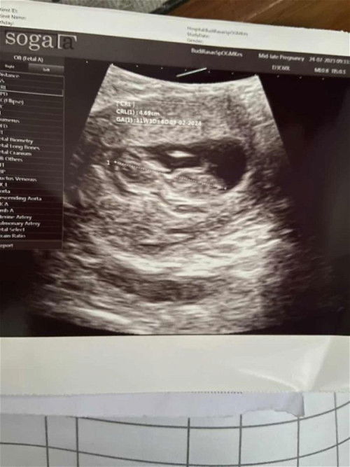 Sempat ada flek di usia 11 minggu