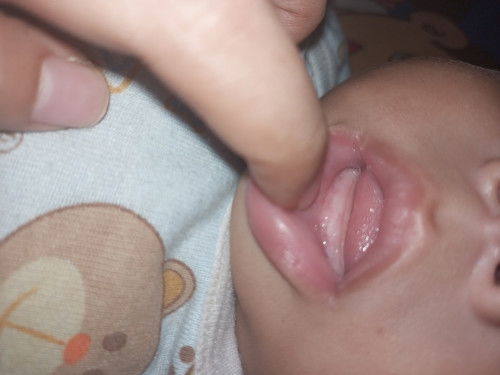 Apaini mau tumbuh gigi Bun? Anakku umur 6 bulan gusinya dipegang kaya bentol gitu