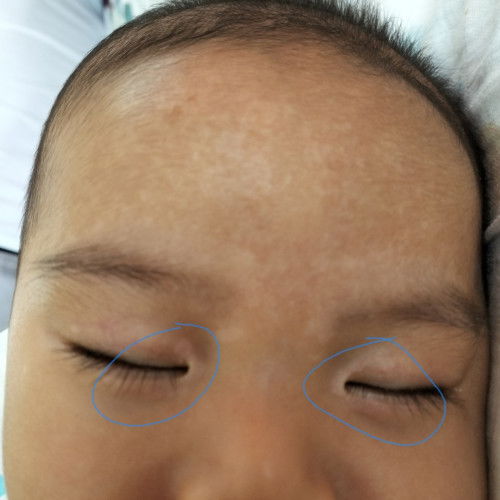 Puti puti sa gilid ng mga mata