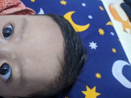 bercak bercak putih di wajah bayi