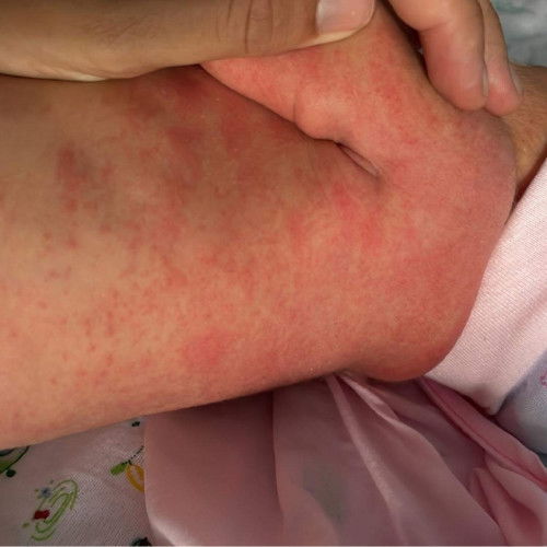 แบบนี้เรียกว่าผื่นอะไรคะ