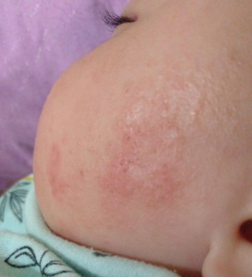 Ruam asi tak kunjung sembuh