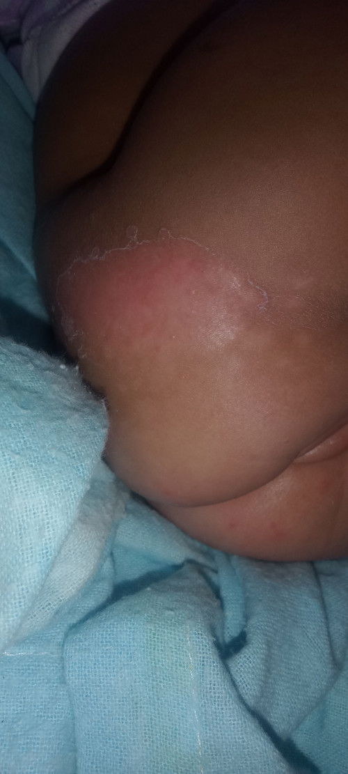 Magaling na po sya pero gusto ko mawala yung bakas nung pinagrashesan.