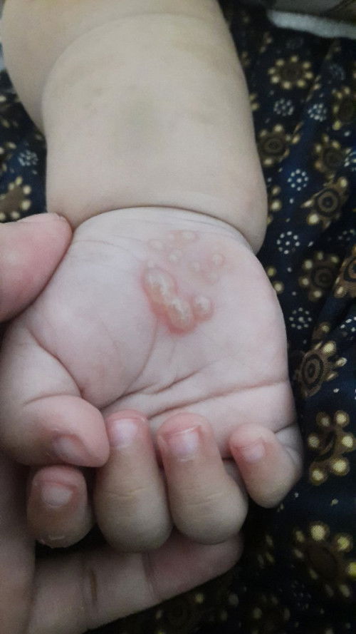 Alergi ikan, telur dan seafood