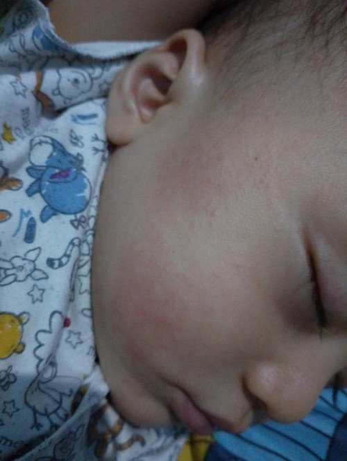 Hallo bund anak saya pipinya ruam merah barang kali ada yang tau cara atasin nya sama obat nya bund