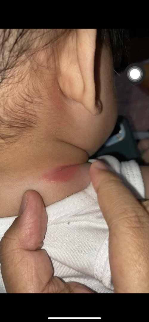 Rash sa leeg ni baby
