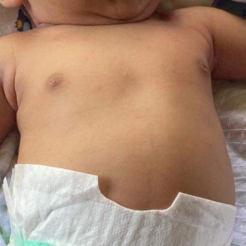 น้องหายใจแล้วหน้าอกบุ๋ม ปกติมั้ยคะ