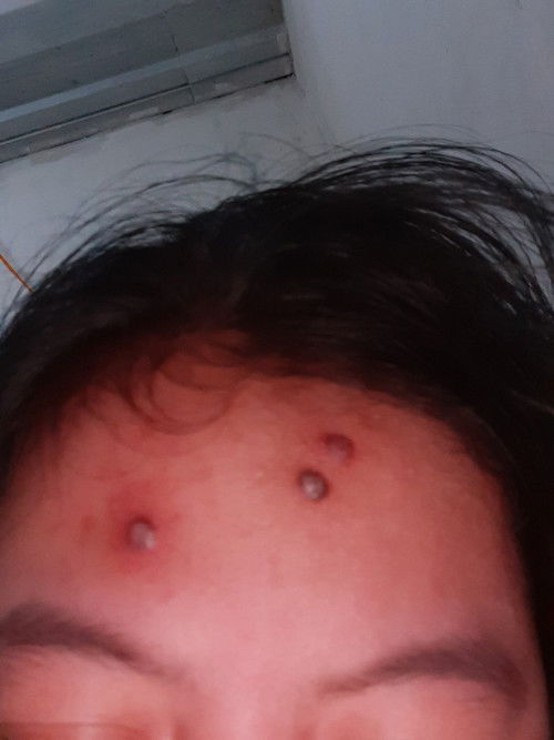 Ini jerawat atau bukan ya