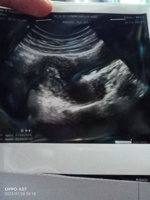 Hamil 1 bUlan tapi keluar darah kaya haid udh 2 hari