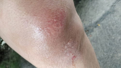 หกล้มเอาเข่าลง 22 w