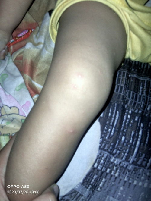 Bentol isi air pd anak