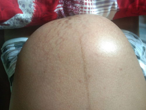 38weeks Anterior Placenta