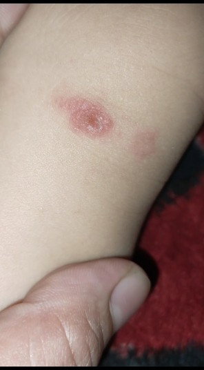 Ini beneran cacar ya