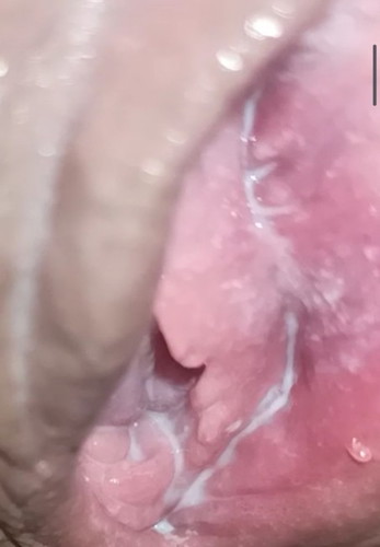 yeast infection ?