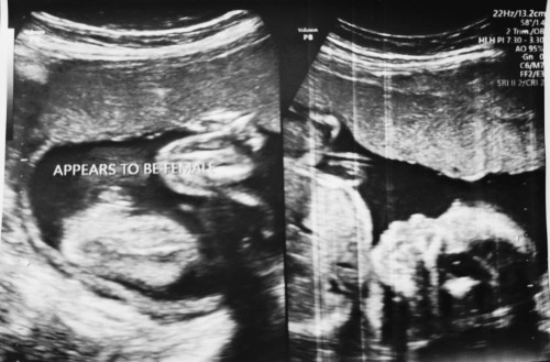 hindi ko po kasi alam pano tumingin, saan po kaya jan nakikita na girl si baby?