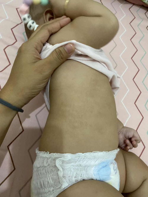 Kulit kering sekitar badan bayi