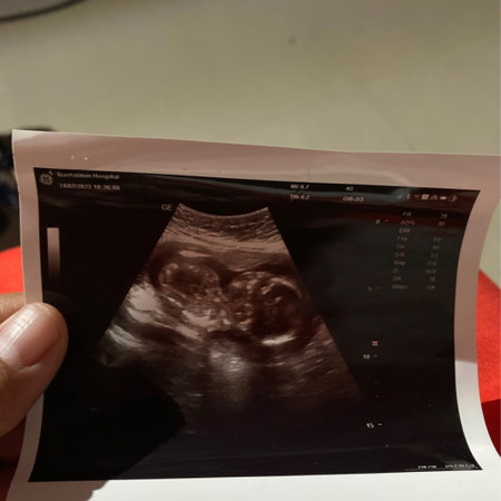 19+1 อัลตราซาวด์ล่าสุด