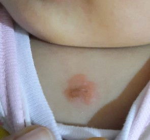 Bintik merah makin lebar