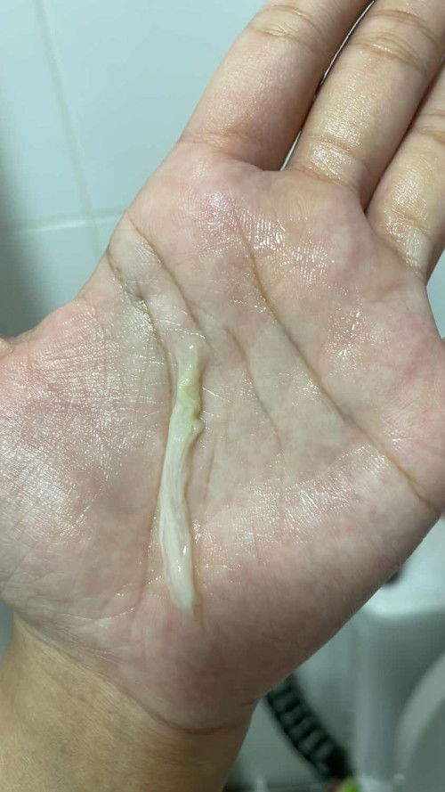 White jelly discharge (17w)