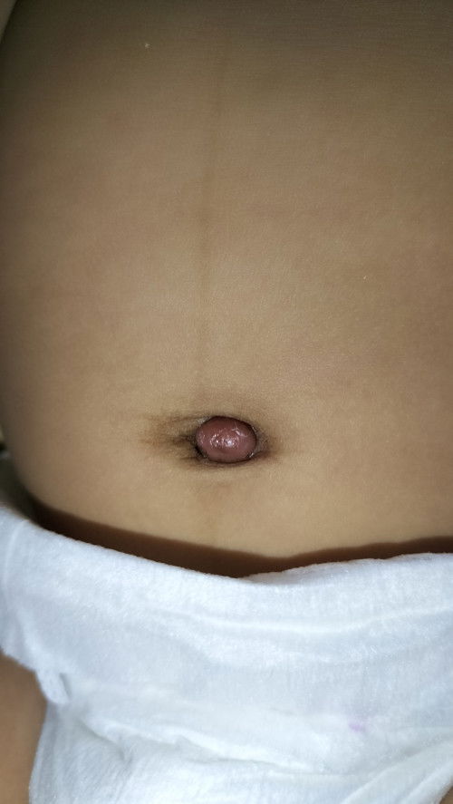 สะดือจุ่นหรือป่าวคะ