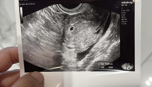 Alhamdulillah, nampak kantung dan baby