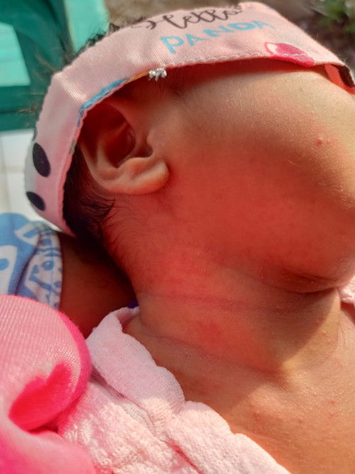 Beruntusan merah pada bayi baru lahir