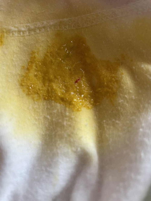 Darah pada fesea bayi