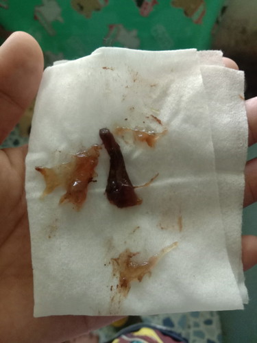 มะวานโดนกระตุ่นปากมดลูกมา39+6วันกำหนดคลอดวันนี้ปากหมดลูกเปิดแค่1เชน