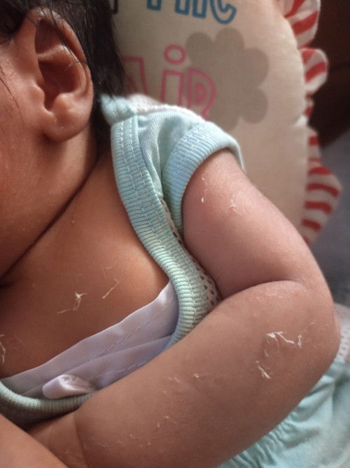 Bayi kulit mengelupas/skin shedding