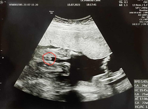 ลูกคนที่2ตื่นเต้นกันไหมคะ
