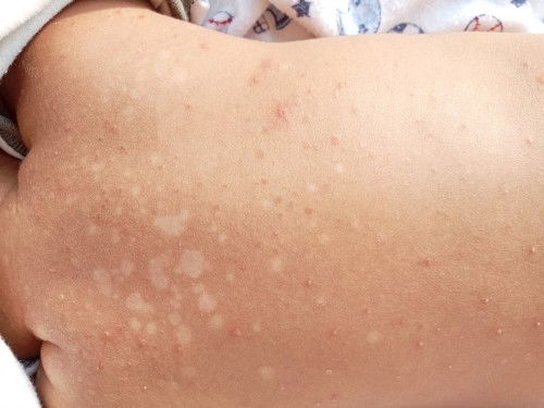 Ruam di punggung bayi 1,5 bulan