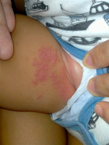 Baby Rashes