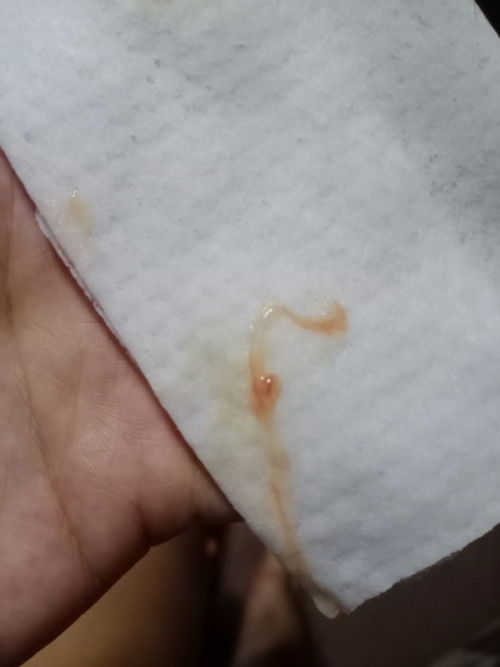 normal discharge or sign na nag oopen na cervix ?