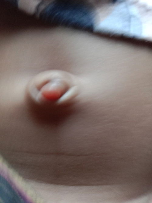 Ada yang tau ini kenapa? Bahaya tidak ya? Gimana cara nyembuhkannya? Anak sya baru usia 1 bulan....