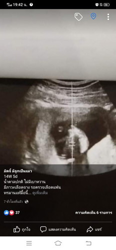 เราท้อง14W5d
คุณหมอซาวด์เจอแค่นี้ ปกติรึปล่าวคะ กังวลมาก