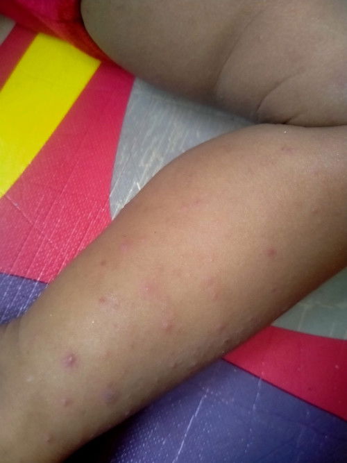 Bun kalau boleh tau apa ya obat nya kalau macam ini