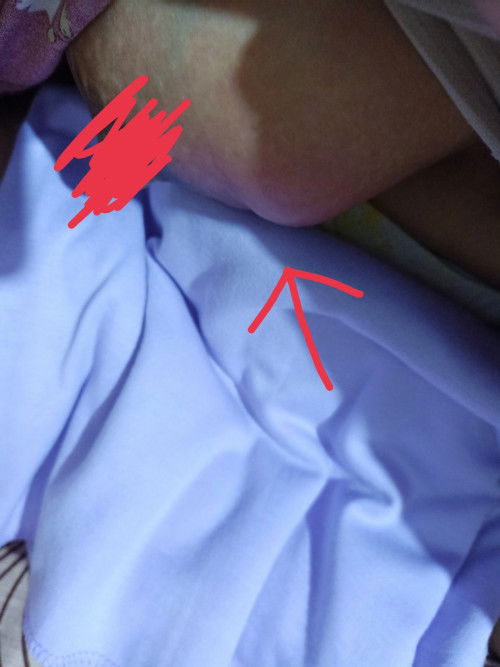 PD bengkak merah meradang