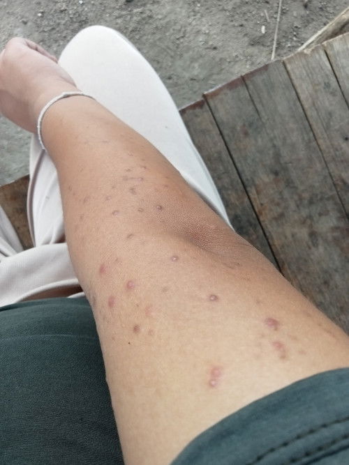 ผื่นคันขึ้น