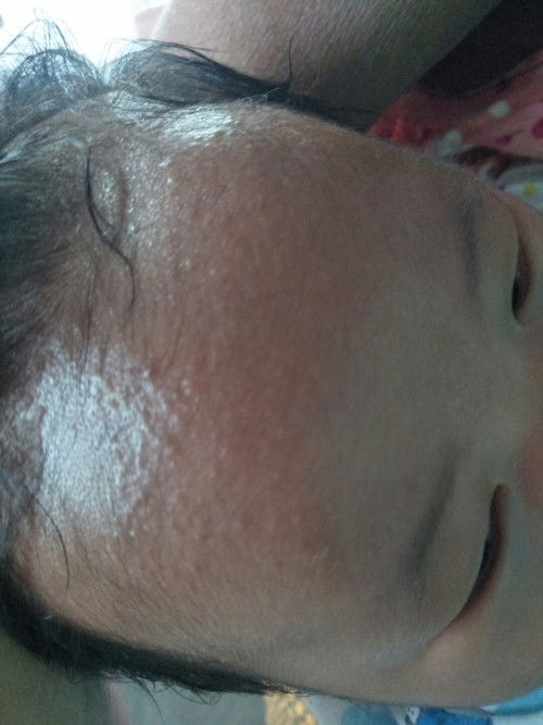 แบบนี้เรียกผดร้อนหรือแพ้นมวัวค่ะ
น้อง1เดือน10วันน้องกินนมผงกับนมแม่บ้างครั้ง