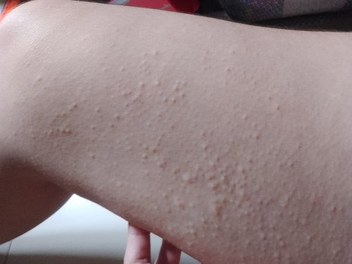 Skin Allergy