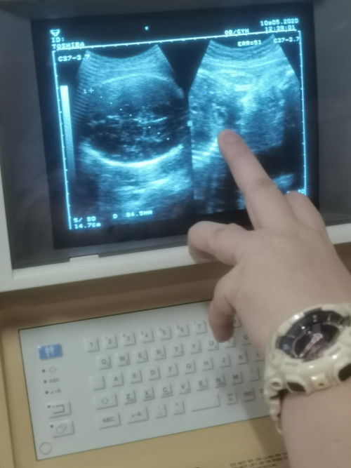 33 weeks and 6 days🙏🏻