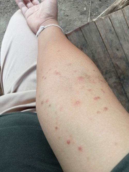 ผื่นคันขึ้น