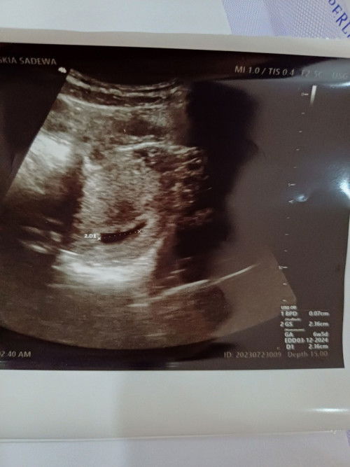 Kantung kehamilan tidak berbentuk bulat