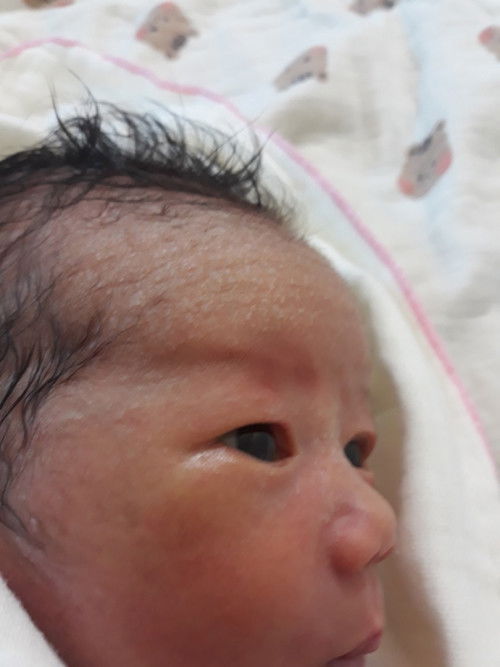 Các mon cho em hỏi bé bị mụn như vầy có sao k a