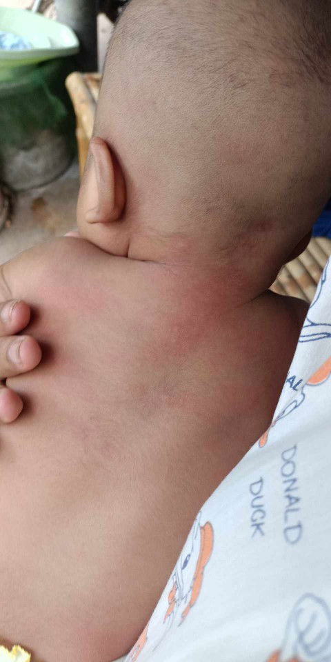 ผื่นขึ้นตามตัวและหน้า